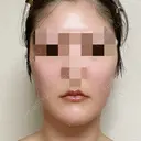 脂肪吸引（顔） 銀座マイアミ美容外科 DAY 86 サムネイル用