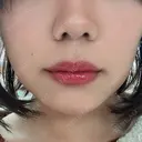 ヒアルロン酸注入（鼻） / ヒアルロン酸注入（唇） / ボトックス（口角） THE FIRST CLINIC 多摩センター院 DAY 2 サムネイル用