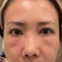 クマ治療 X CLINIC 銀座院 DAY 2 サムネイル用