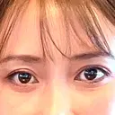 クマ治療 X CLINIC 銀座院 AFTER サムネイル用