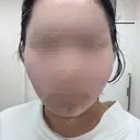 糸リフト / 脂肪吸引（顔） ルラ美容クリニック 大阪本院 AFTER サムネイル用