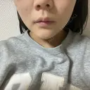 ボトックス（エラ・小顔） / 脂肪溶解注射（顔） TCB東京中央美容外科 京都駅前院 AFTER サムネイル用