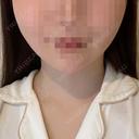 脂肪吸引（顔） / あご下筋肉縛り セギム美容整形外科 AFTER サムネイル用