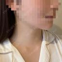 脂肪吸引（顔） / あご下筋肉縛り セギム美容整形外科 DAY 39 サムネイル用