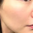 エレクトロポレーション / 毛穴洗浄（ハイドラフェイシャルなど） Re：HADA CLINIC 銀座 DAY 0 サムネイル用