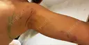 脂肪吸引（顔） / 脂肪吸引（二の腕） / 脂肪注入（額） / 脂肪吸引（肩） Mods Clinic（モッズクリニック） 福岡院 DAY 3 サムネイル用