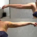 脂肪吸引（顔） / 脂肪吸引（二の腕） / 脂肪注入（額） / 脂肪吸引（肩） Mods Clinic（モッズクリニック） 福岡院 DAY 6 サムネイル用