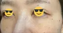 下まぶたの脂肪取り / 脂肪注入（目の下） セオリークリニック DAY 7 サムネイル用