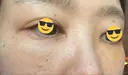 下まぶたの脂肪取り / 脂肪注入（目の下） セオリークリニック DAY 7 サムネイル用