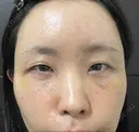 クマ治療 / こめかみ形成 / 脂肪注入（額） / 脂肪注入（目の下） / ボトックス（額） X CLINIC 銀座院 DAY 11 サムネイル用