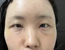 クマ治療 / こめかみ形成 / 脂肪注入（額） / 脂肪注入（目の下） / ボトックス（額） X CLINIC 銀座院 DAY 13 サムネイル用
