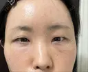 クマ治療 / こめかみ形成 / 脂肪注入（額） / 脂肪注入（目の下） / ボトックス（額） X CLINIC 銀座院 DAY 14 サムネイル用
