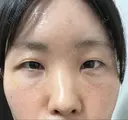 クマ治療 / こめかみ形成 / 脂肪注入（額） / 脂肪注入（目の下） / ボトックス（額） X CLINIC 銀座院 DAY 15 サムネイル用