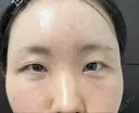 クマ治療 / こめかみ形成 / 脂肪注入（額） / 脂肪注入（目の下） / ボトックス（額） X CLINIC 銀座院 DAY 16 サムネイル用