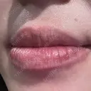 ルビーレーザー S-Laboクリニック 渋谷院 DAY 0 サムネイル用