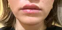 ヒアルロン酸注入（唇） 麻布十番クレールデンタルクリニック AFTER サムネイル用