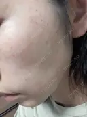 光治療（フォトフェイシャルなど） DMTC美容皮膚科 大宮院 AFTER サムネイル用