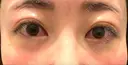 クマ治療 藤・ナチュレ美容クリニック 銀座院 DAY 0 サムネイル用