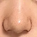 鼻尖形成（切開） / 小鼻縮小（切開） / その他（鼻） 東京形成美容外科 船橋院 DAY 6 サムネイル用