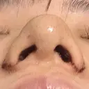 鼻尖形成（切開） / 小鼻縮小（切開） / その他（鼻） 東京形成美容外科 船橋院 DAY 6 サムネイル用