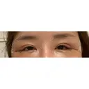 目尻靭帯移動 ヴェリテクリニック 銀座院 DAY 2 サムネイル用