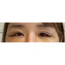 目尻靭帯移動 ヴェリテクリニック 銀座院 DAY 3 サムネイル用