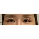 目尻靭帯移動 ヴェリテクリニック 銀座院 DAY 9 サムネイル用