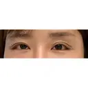 目尻靭帯移動 ヴェリテクリニック 銀座院 DAY 40 サムネイル用