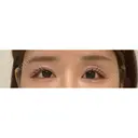 目尻靭帯移動 ヴェリテクリニック 銀座院 DAY 41 サムネイル用