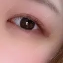 骨切り（あご） / 骨削り（エラ） / 骨削り（頬） / その他（輪郭） / ヒアルロン酸溶解 アーククリニック DAY 5 サムネイル用