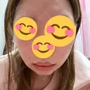 骨切り（あご） / 骨削り（エラ） / 骨削り（頬） / その他（輪郭） / ヒアルロン酸溶解 アーククリニック DAY 6 サムネイル用