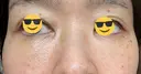 下まぶたの脂肪取り / 脂肪注入（目の下） セオリークリニック AFTER サムネイル用