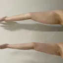 脂肪吸引（二の腕） / 脂肪吸引（肩） Mods Clinic（モッズクリニック） 大阪院 DAY 29 サムネイル用