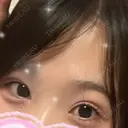 二重埋没 / 目頭切開 城本クリニック 長崎院 AFTER サムネイル用