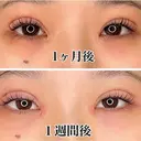 二重埋没 / 目頭切開 城本クリニック 長崎院 DAY 132 サムネイル用