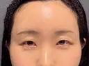 クマ治療 / こめかみ形成 / 脂肪注入（額） / 脂肪注入（目の下） / ボトックス（額） X CLINIC 銀座院 DAY 25 サムネイル用