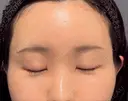 クマ治療 / こめかみ形成 / 脂肪注入（額） / 脂肪注入（目の下） / ボトックス（額） X CLINIC 銀座院 DAY 25 サムネイル用