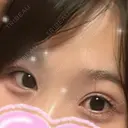 ヒアルロン酸注入（涙袋） 城本クリニック 長崎院 DAY 359 サムネイル用