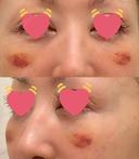 クマ治療 / 下まぶたたるみ取り / 脂肪注入（目の下） / ヒアルロン酸溶解 X CLINIC 大阪院 DAY 10 サムネイル用