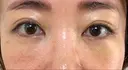 クマ治療 藤・ナチュレ美容クリニック 銀座院 DAY 7 サムネイル用