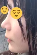 鼻尖形成（切開） / 軟骨移植 / 鼻修正 / 鼻柱下降・鼻唇角形成（猫手術） 東京シンデレラ美容外科 池袋院 AFTER サムネイル用