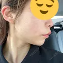 ボトックス（エラ・小顔） ルラ美容クリニック 大宮院 / ルラスキンクリニック 大宮院 DAY 14 サムネイル用