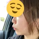 ボトックス（エラ・小顔） ルラ美容クリニック 大宮院 / ルラスキンクリニック 大宮院 DAY 14 サムネイル用