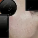 ポテンツァ ARTE BEAUTY CLINIC DAY 4 サムネイル用