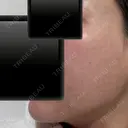 ポテンツァ ARTE BEAUTY CLINIC AFTER サムネイル用