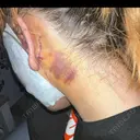 切開リフト 東京エビスクリニック DAY 5 サムネイル用