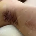 ワキ汗治療（切開） 石倉クリニック 水戸院 DAY 2 サムネイル用