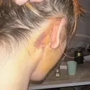 切開リフト 東京エビスクリニック DAY 6 サムネイル用