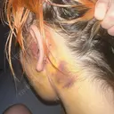 切開リフト 東京エビスクリニック DAY 6 サムネイル用