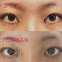 目頭切開 LUHO（ルホ）美容外科 DAY 30 サムネイル用